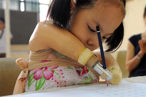 limbless, linh chi, nick, artificial limbs