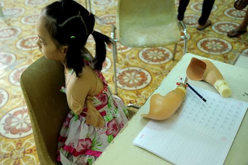 limbless, linh chi, nick, artificial limbs