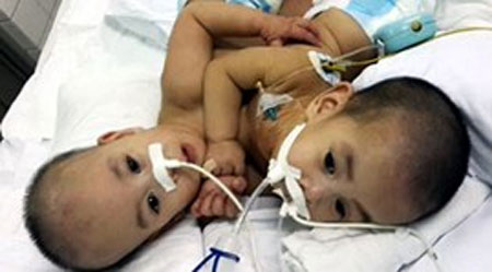 HCM City, Ninh Thuan, conjoined twins, be separated