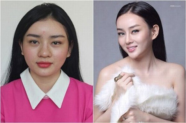 vietnamese plastic surgery before and after