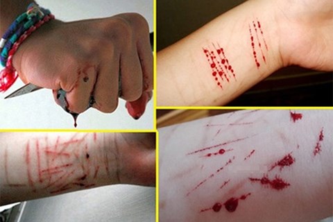 cuts on arms self harm